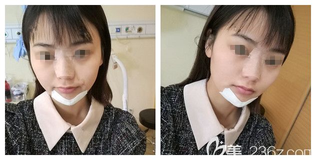 刚做完韩式生科硅胶垫下巴+假体隆鼻术后即刻效果