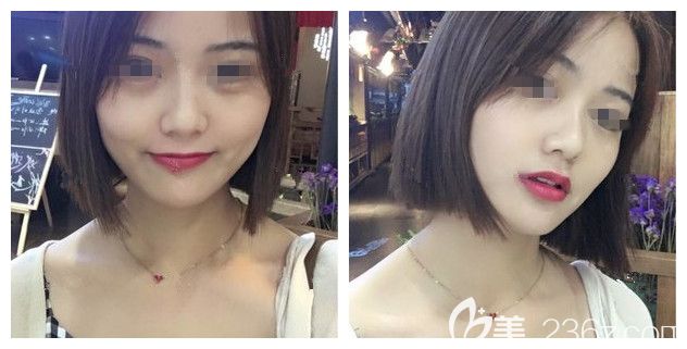 花2万多在做的韩式生科硅胶垫下巴+假体隆鼻，术后get侧颜杀半个月就能化淡妆了