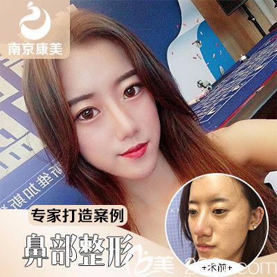 分享隆鼻+面部脂肪填充案例对比