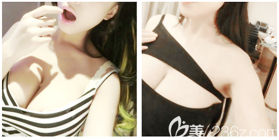 广州美恩整形医院许扬滨做隆胸技术怎么样 广州美恩整形医院许扬滨做隆胸技术怎么样