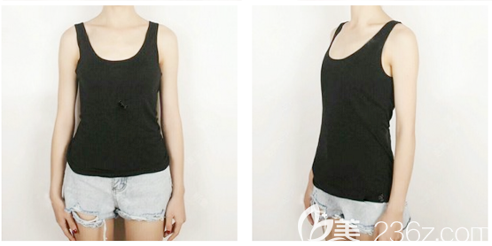 在广州美恩整形医院做隆胸术前照片 在广州美恩整形医院做隆胸术前照片