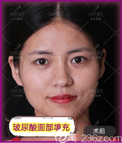 我在北京美莱做玻尿酸面部填充前样子 我在北京美莱做玻尿酸面部填充前样子