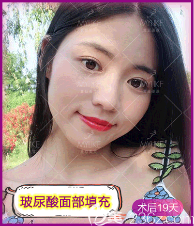 戴琴医生给我做玻尿酸面部填充第19天效果 戴琴医生给我做玻尿酸面部填充第19天效果