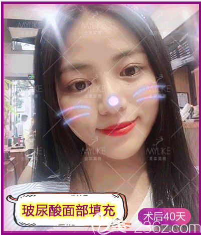 我在北京美莱做玻尿酸面部填充第40天效果 我在北京美莱做玻尿酸面部填充第40天效果