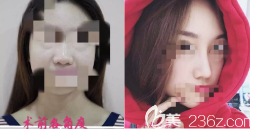 杜太超鼻综合案例