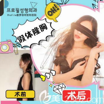 韩国profile医院MOTIVA魔滴假体隆胸案例前后效果对比图 韩国profile医院MOTIVA魔滴假体隆胸案例前后效果对比图