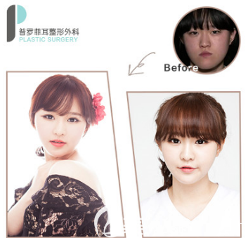 韩国普罗菲耳眼综合整形案例 韩国普罗菲耳眼综合整形案例