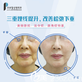 韩国普罗菲耳三重埋线提升案例 韩国普罗菲耳三重埋线提升案例