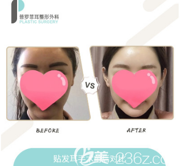韩国贴发耳矫正案例前后效果对比图 韩国贴发耳矫正案例前后效果对比图
