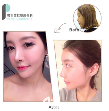 韩国普罗菲耳鼻综合隆鼻案例 韩国普罗菲耳鼻综合隆鼻案例