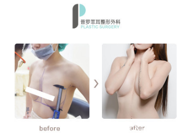 韩国蓓拉假体隆胸真人案例 韩国蓓拉假体隆胸真人案例