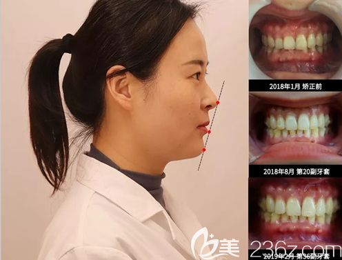 贾艳主任给自己做的隐形矫正效果图