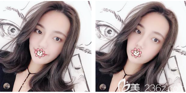 <!--<i data=20240703-sp></i>-->整形医院李鹏医生割双眼皮案例 <!--<i data=20240703-sp></i>-->整形医院李鹏医生割双眼皮案例