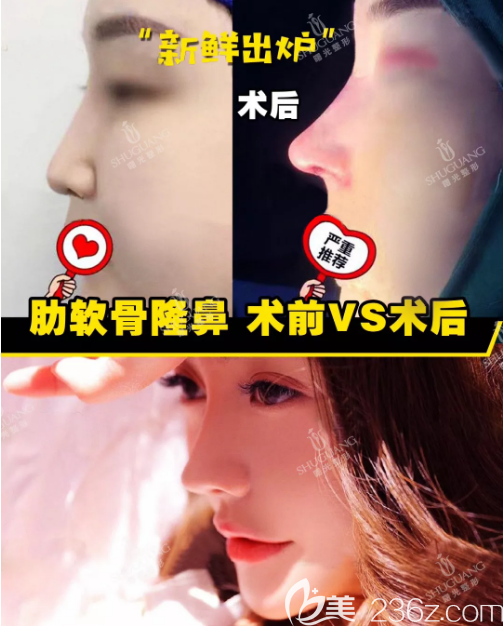 梅州曙光整形医院肋软骨隆鼻案例