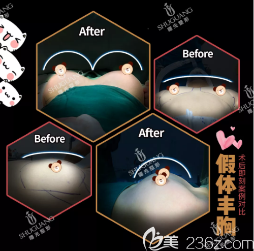 梅州曙光整形医院假体隆胸案例