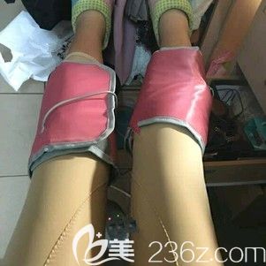 刚做完大腿环吸术后消肿恢复阶段 刚做完大腿环吸术后消肿恢复阶段