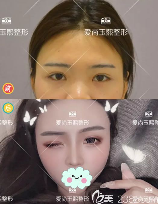 朱刚强隆鼻案例