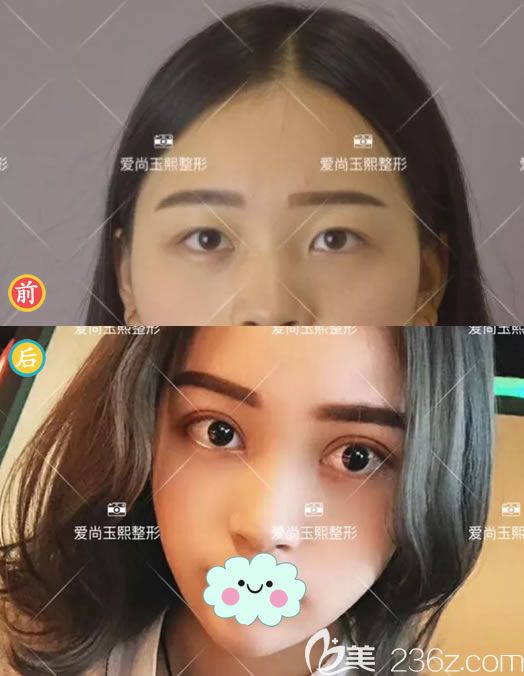 郑静伟院长双眼皮案例