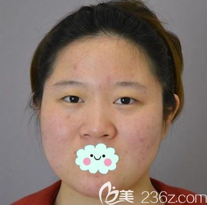 在<!--<i data=20240703-sp></i>-->做鼻综合隆鼻前 在<!--<i data=20240703-sp></i>-->做鼻综合隆鼻前