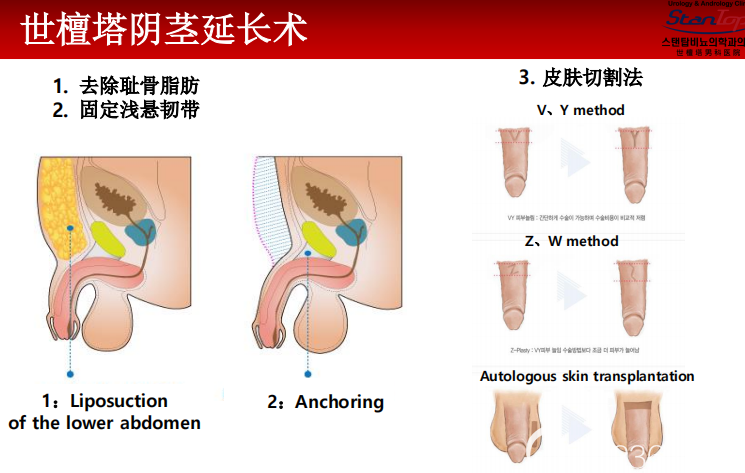 韩国世檀塔男科阴茎延长