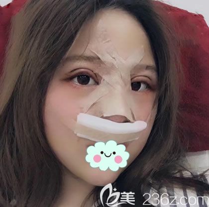 刚做完肋软骨鼻综合隆鼻效果 刚做完肋软骨鼻综合隆鼻效果