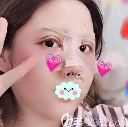 找<!--<i data=20240703-sp></i>-->朱刚强做鼻子4天后 找<!--<i data=20240703-sp></i>-->朱刚强做鼻子4天后