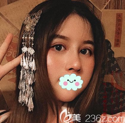 做肋软骨隆鼻拆线3天效果图片 做肋软骨隆鼻拆线3天效果图片