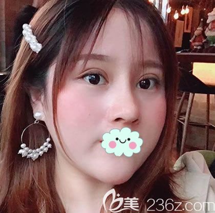 从事前台工作的妹子来强做了肋软骨鼻综合隆鼻手术