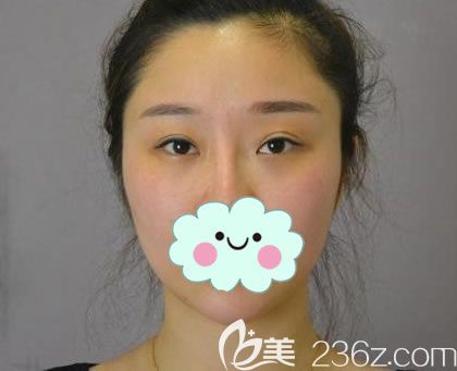 天生的双眼皮却左右不对称 天生的双眼皮却左右不对称