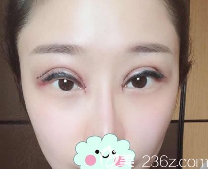 刚做完双眼皮手术图片 刚做完双眼皮手术图片