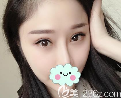 在<!--<i data=20240703-sp></i>-->做双眼皮矫正30天后 在<!--<i data=20240703-sp></i>-->做双眼皮矫正30天后