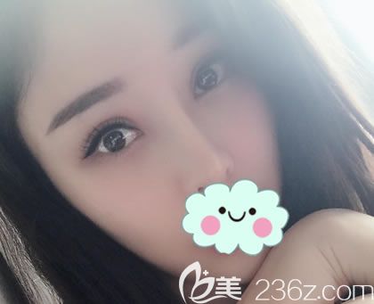 我虽然是天生双眼皮,但双眼皮不对称,考虑后选择郑静伟做了双眼皮和开眼角