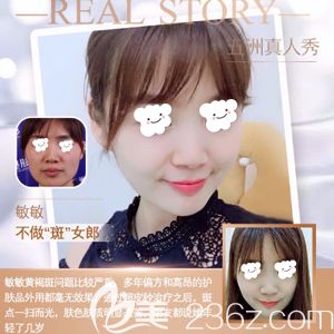 五洲莱美黄媛媛主任做超皮秒祛斑真人案例 五洲莱美黄媛媛主任做超皮秒祛斑真人案例