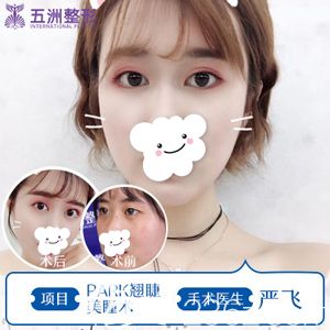 严飞院长做精切双眼皮术前术后对比 严飞院长做精切双眼皮术前术后对比