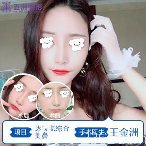 王金洲医生做达拉斯综合隆鼻术后100天恢复自然 王金洲医生做达拉斯综合隆鼻术后100天恢复自然