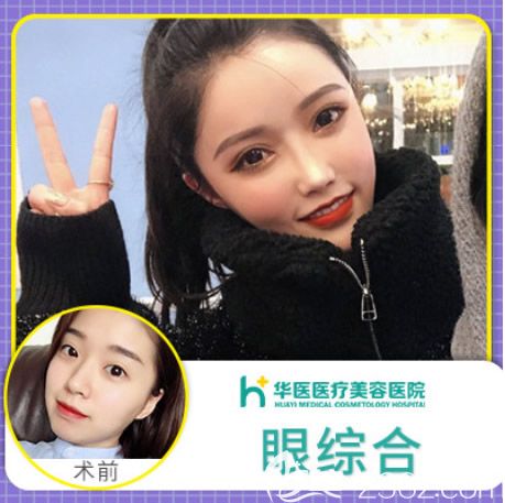 呼和浩特华医整形王春燕全切双眼皮+开眼角效果案例分