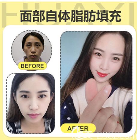 呼市华医整形宋耀宗面部脂肪填充效果怎么样