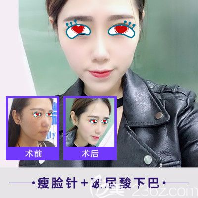 合肥崔劲松瘦脸+玻尿酸丰下巴前后效果对比图 合肥崔劲松瘦脸+玻尿酸丰下巴前后效果对比图