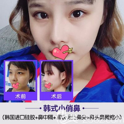 合肥哪家医院龙隆鼻比较好?崔劲松整形鼻综合案例效果来验证 合肥哪家医院龙隆鼻比较好?崔劲松整形鼻综合案例效果来验证