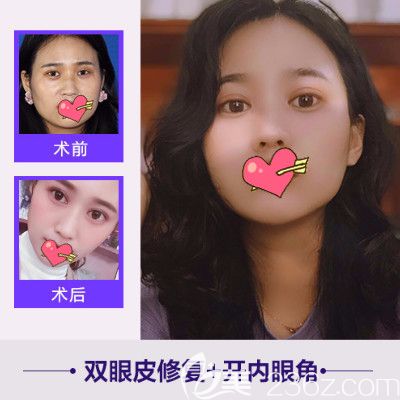 合肥崔劲松整形双眼皮失败修复案例公布 合肥崔劲松整形双眼皮失败修复案例公布