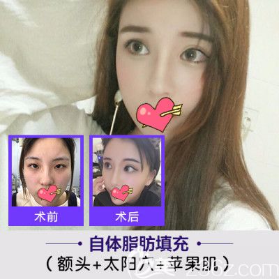 崔劲松整形自体脂肪填充额头+太阳穴+苹果肌前后效果对比 崔劲松整形自体脂肪填充额头+太阳穴+苹果肌前后效果对比