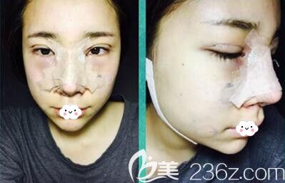 韩国乐希lush双眼皮开眼角+鼻综合隆鼻术后第2天照片