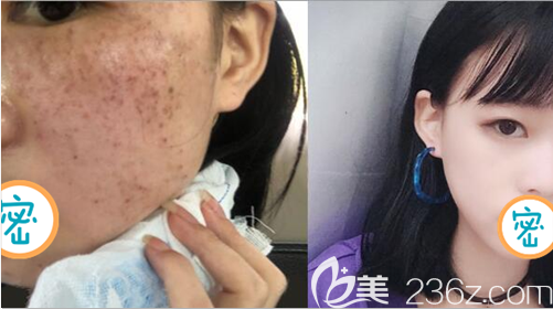 内江达芬奇激光祛斑术前术后对比效果图