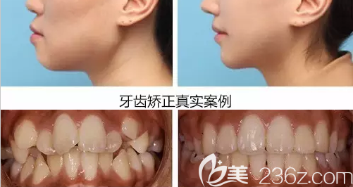 无锡佳士洁口腔牙齿矫正真人案例前后对比效果图 无锡佳士洁口腔牙齿矫正真人案例前后对比效果图
