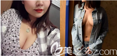 <!--<i data=20240703-sp></i>-->医生给我做宫廷内窥镜复合隆胸第35天<span style=