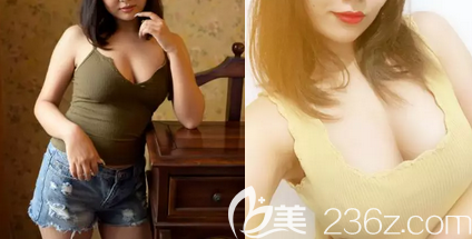 我在北京艺星做宫廷内窥镜假体复合隆胸第62天<span style=