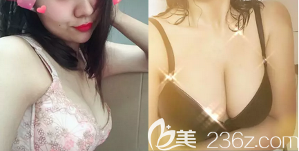 内窥镜假体隆胸怎样？北京艺星宫廷内窥镜复合隆胸<span style=