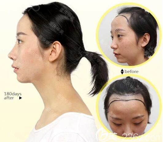 重庆华美整形发际线种植案例