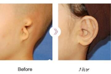 韩国Profile医院耳朵畸形手术成功案例
