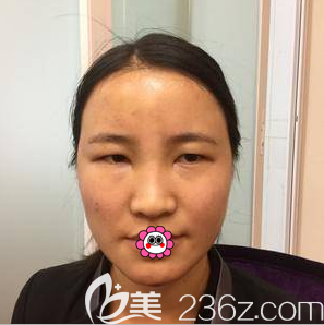 高海燕医生给我做自体脂肪面部填充第4天样子